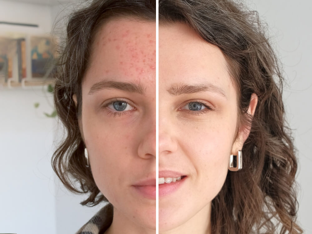 Skin Rejuvenation